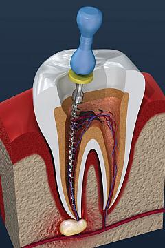 Endodontski tretman zuba u ordinaciji